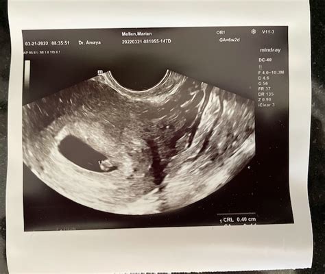 miscarriage at 6 weeks pregnant.